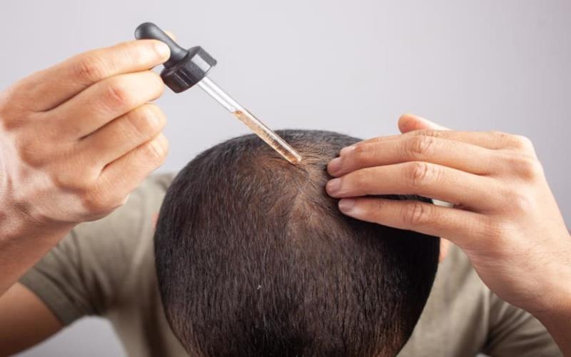 Uncovering Minoxidil: How This Powerful Treatment Can Stop Hair Loss
