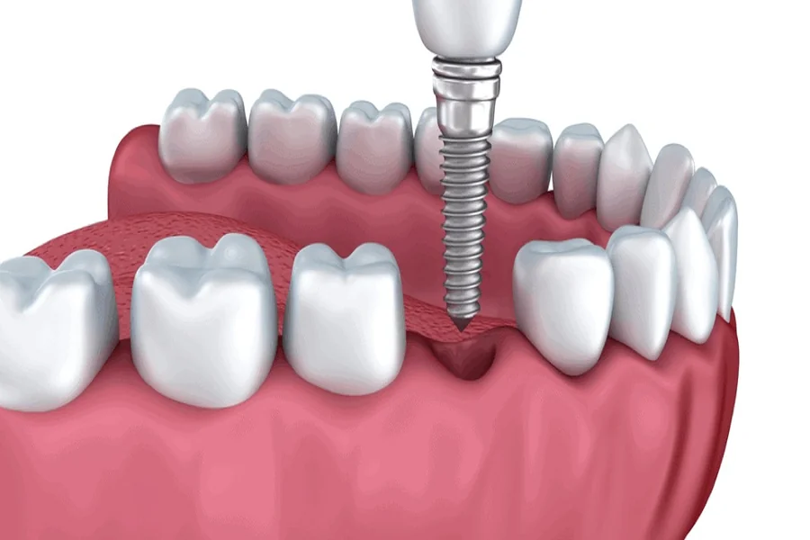Why Periodontists Are Essential For Healthy Gums And Implants Healthy Gums