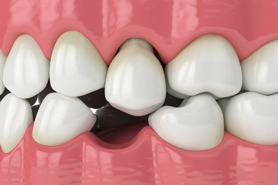 3 Reasons To Replace Even A Single Missing Tooth Tooth