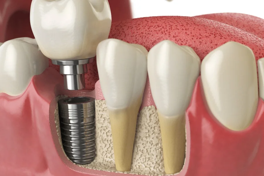 4 Steps Involved In The Implant Dentistry Process Implant